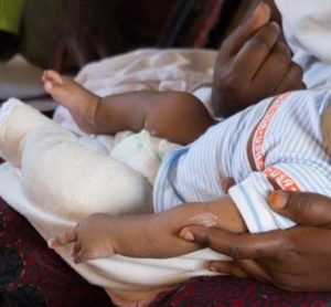 clubfoot