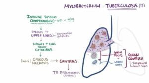 Tuberculosis