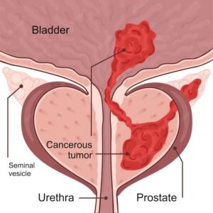 Prostate