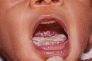 An image showing how oral thrush seems like in its patient's mouth.