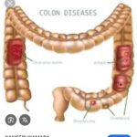 Sobanukirwa indwara ya kanseri y’amara (colorectal cancer)